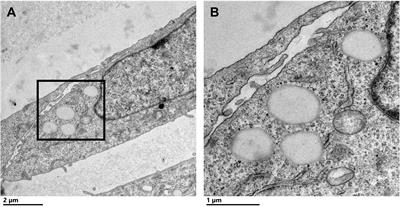 Proteomic Characterization of Cytoplasmic Lipid Droplets in Human Metastatic Breast Cancer Cells